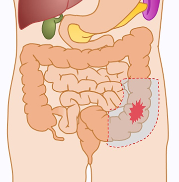 S状結腸がんに対するS状結腸切除術の切除範囲