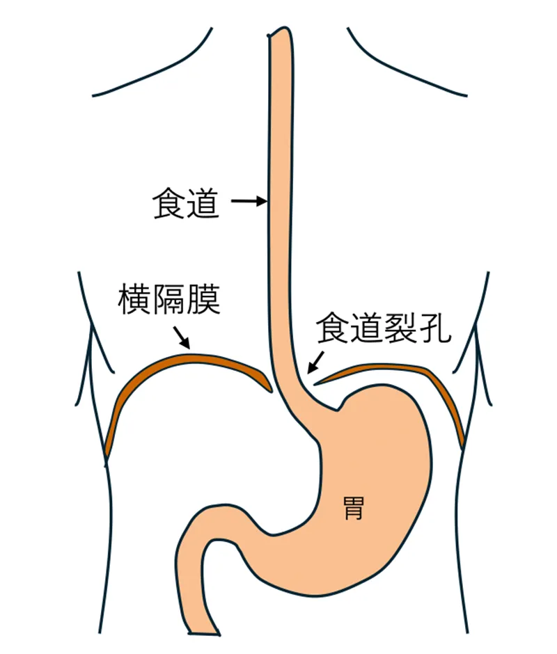 食道裂孔ヘルニアとは