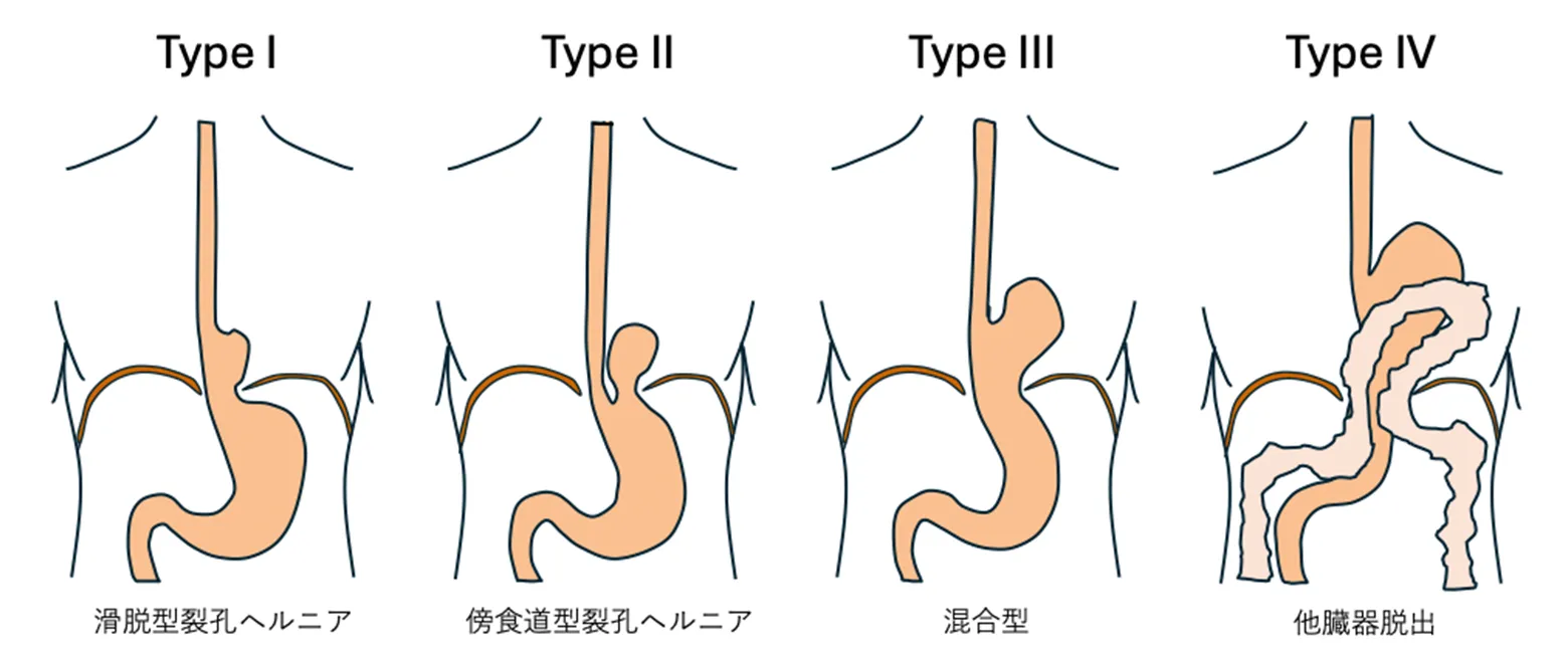 食道裂孔ヘルニアとは