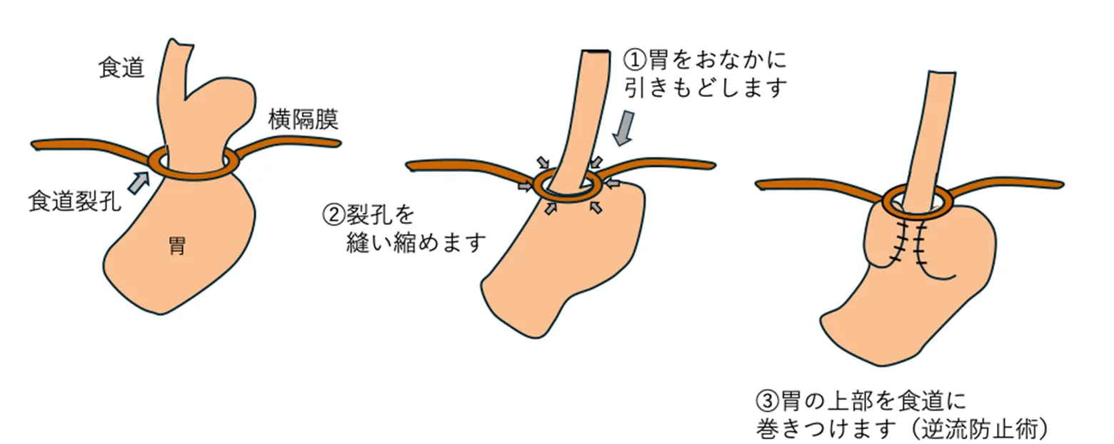 食道裂孔ヘルニアの手術について