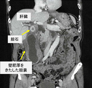 腹腔鏡下胆嚢摘出術 医療法人社団 誠馨会 新東京病院